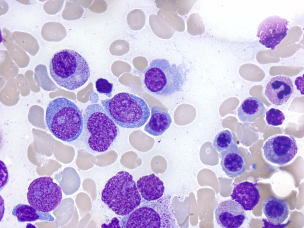 Bone marrow aspirate, Wright stain, 1000x